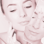 acne scar treatment